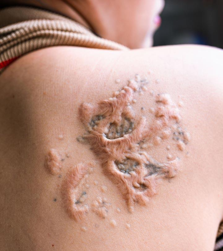 5 Causes Of A Tattoo Rash And How To Treat It  SkinKraft