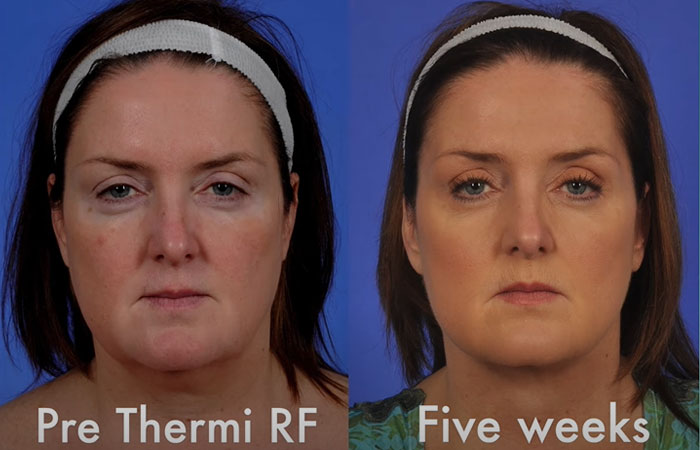 Thermitight treatment before and after pictures
