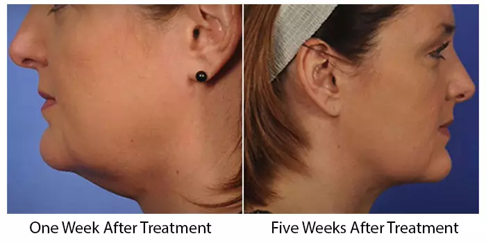 Thermitight treatment before and after pictures