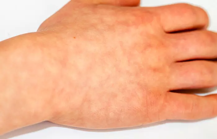 What is toasted skin syndrome