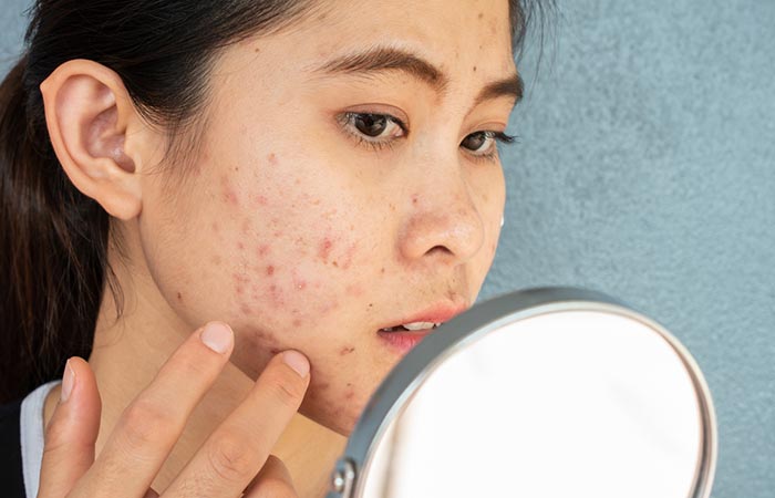 Woman with acne may benefit from neem oil