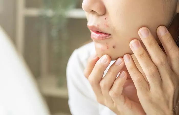 Acne breakouts cause comedones, pustules, and papules around the mouth.