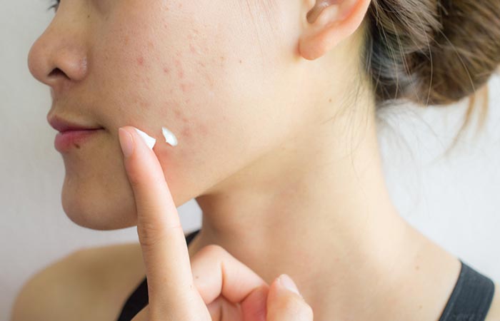 Use salicylic acid or benzoyl peroxide to manage acne around the mouth.