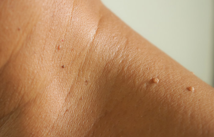 Woman with skin tags on her shoulders