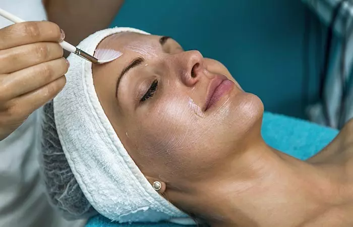 What is a chemical peel