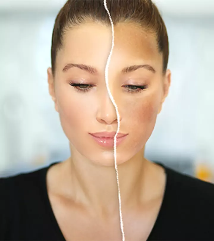What Is The Difference Between Melasma And Hyperpigmentation