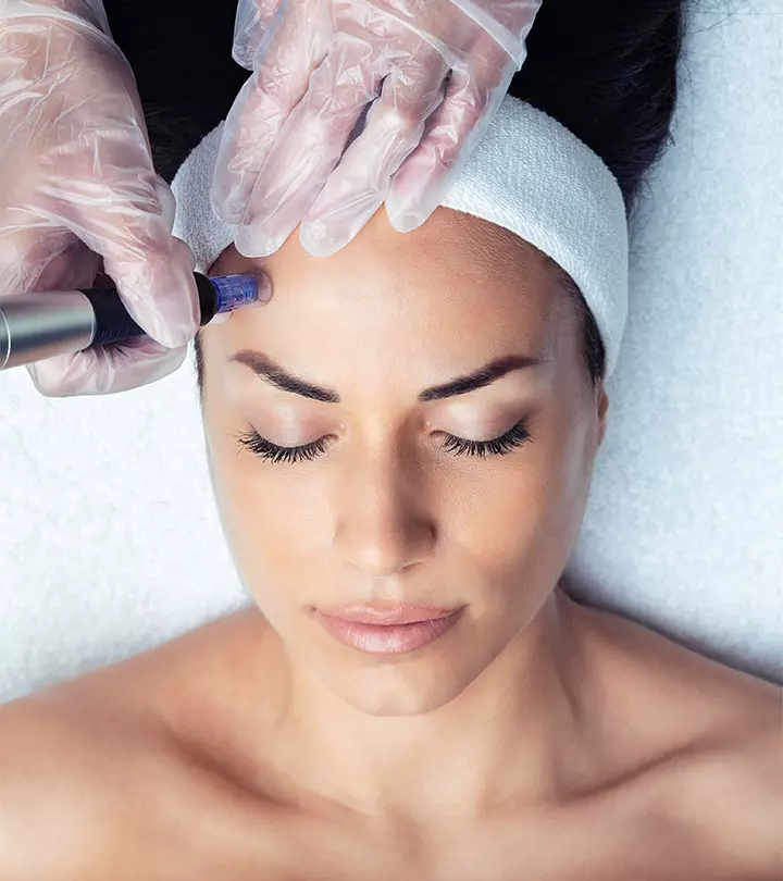 What Role Does Microneedling Play In Acne Scar Treatment