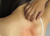 The Red Circle On Your Skin Might Not Be Ringworm; What Else ...
