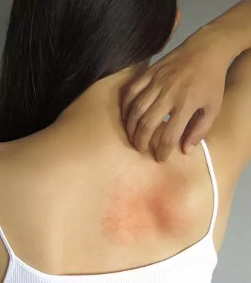 A-Red-Circle-On-Your-Skin-Might-Not-Be-Ringworm