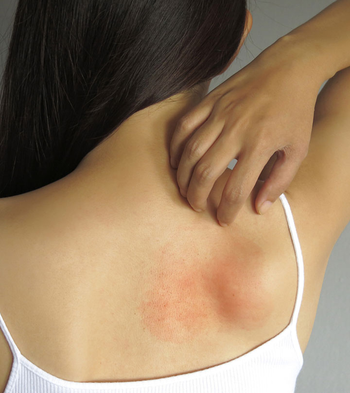 The Red Circle On Your Skin Might Not Be Ringworm; What Else ...