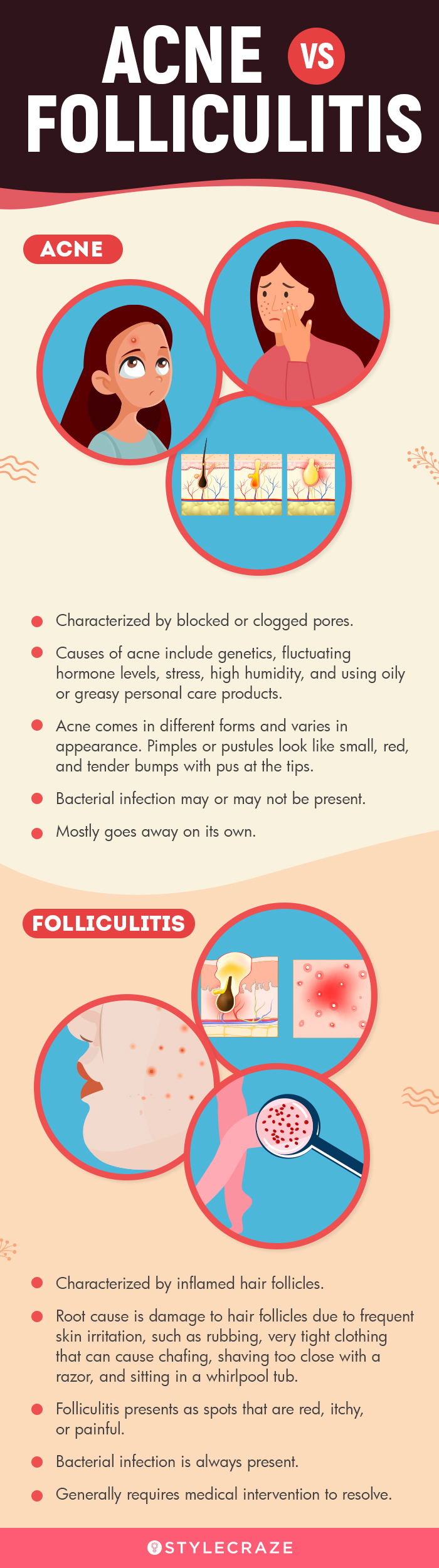acne vs folliculitis (infographic)