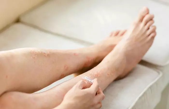 Woman with eczema applying coconut oil on her legs