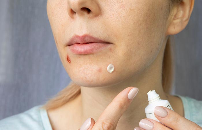 Woman applying Clindamycin on acne