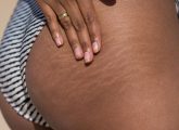 Stretch Marks On The Butt: Causes And How To Get Rid Of Them