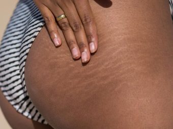 Can You Get Rid Of Stretch Marks On The Butt