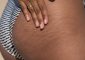 Stretch Marks On The Butt: Causes And...