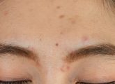 Acne Between Eyebrows: Causes, Treatment, & Prevention Tips