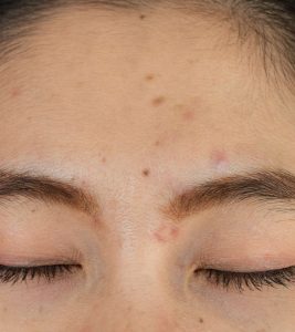 Everything You Need To Know About Acne Between Eyebrows