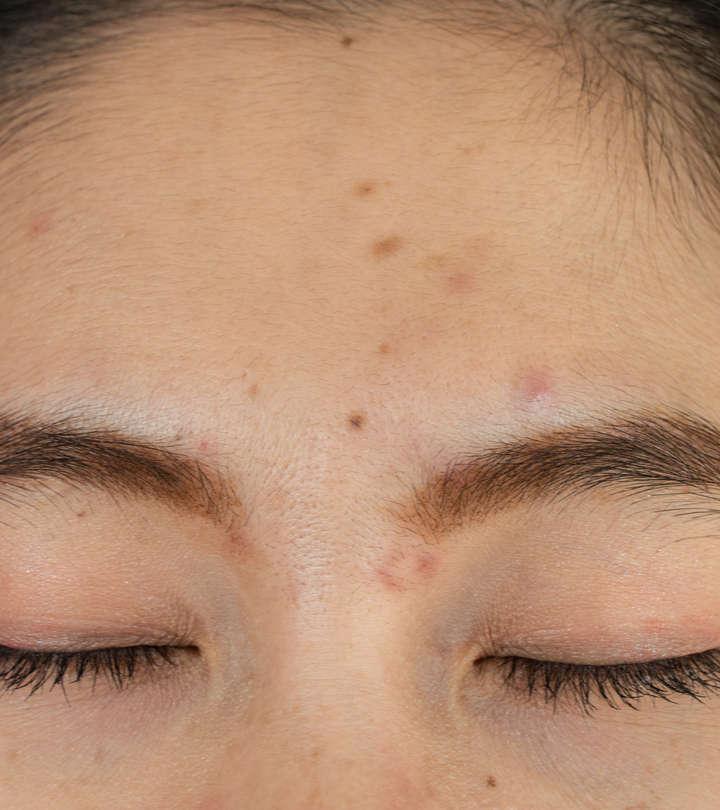 acne-between-eyebrows-causes-treatment-prevention-tips