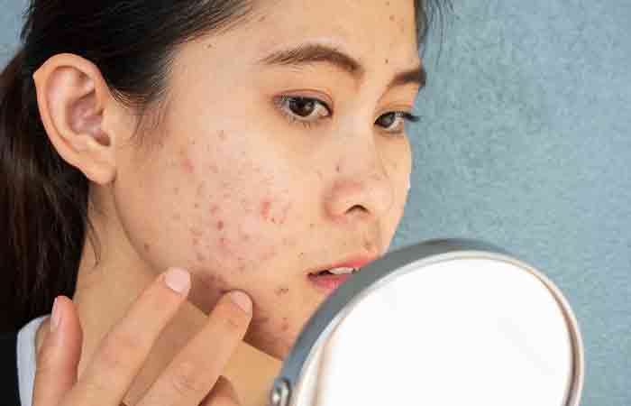 Woman with acne may benefit from pumpkin seed oil