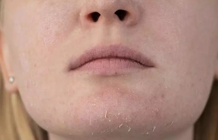 Woman with dry skin may benefit from beta-glucans