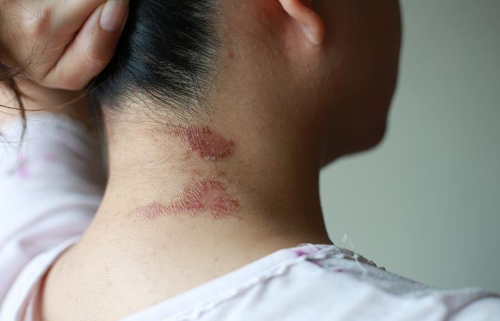 Closeup of rashes caused by contact dermatitis at the nape of the neck