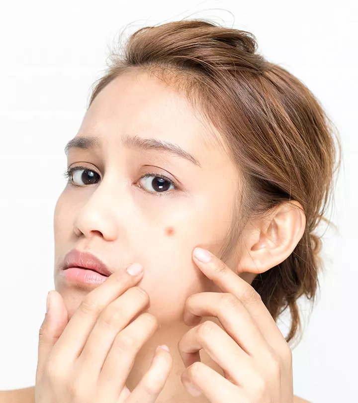 Clindamycin For Acne: How To Use, Benefits, And Side Effects