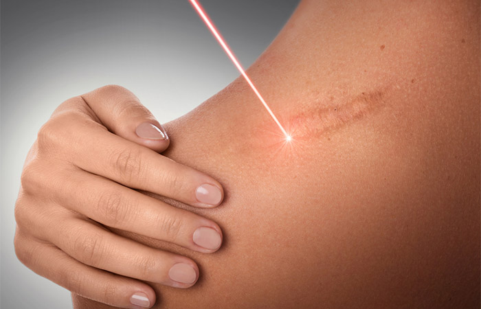 Laser therapy for scar treatment