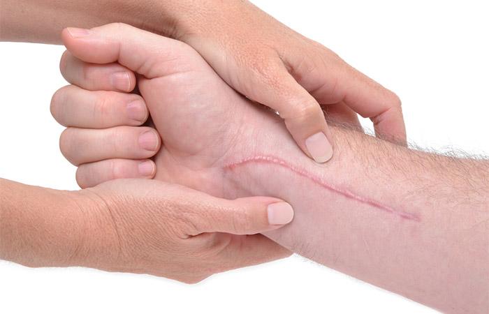Massage reduces the look of scars