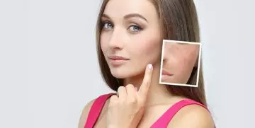 Woman showing her hyperpigmented face