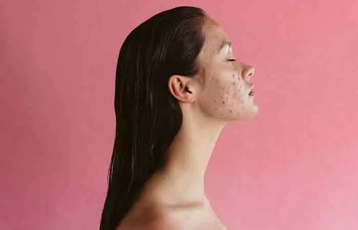 Keto and Atkins diets may reduce acne