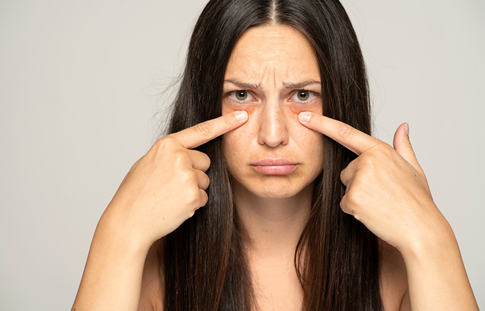 Woman worried about her dark circles