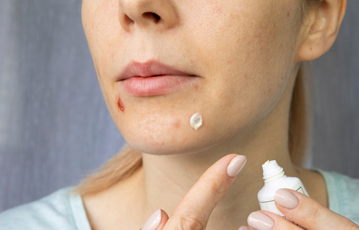 Woman applying topical medication to her face scabs
