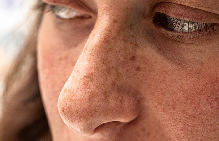 Woman with sun-damaged skin may benefit from beta-glucans