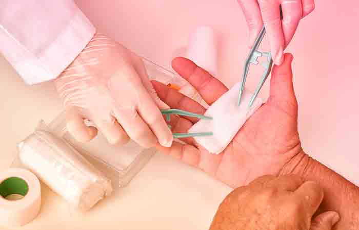 Surgeon cleaning and dressing wound on hand with hypochlorous acid after surgery 