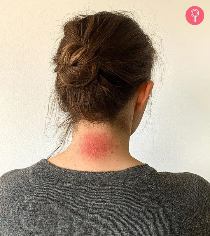 The red circle mark on a girl's back shoulder