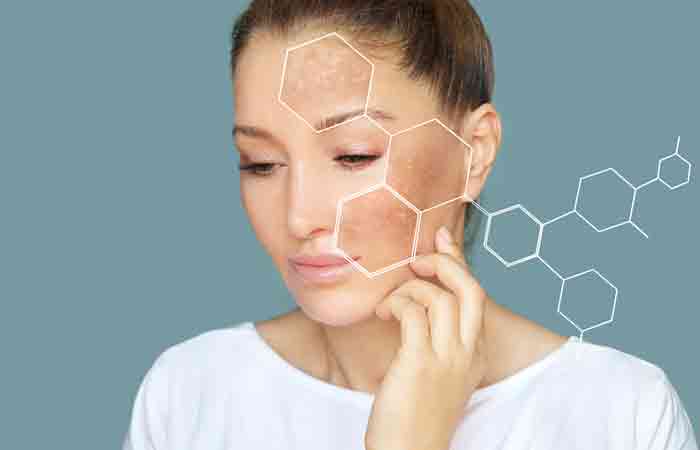 Woman with hyperpigmentation may benefit from pumpkin seed oil