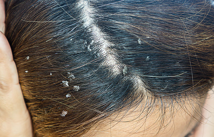 Scalp Infections
