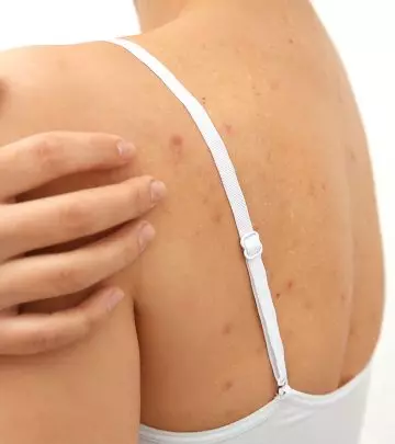 Shoulder Acne Causes And Treatment