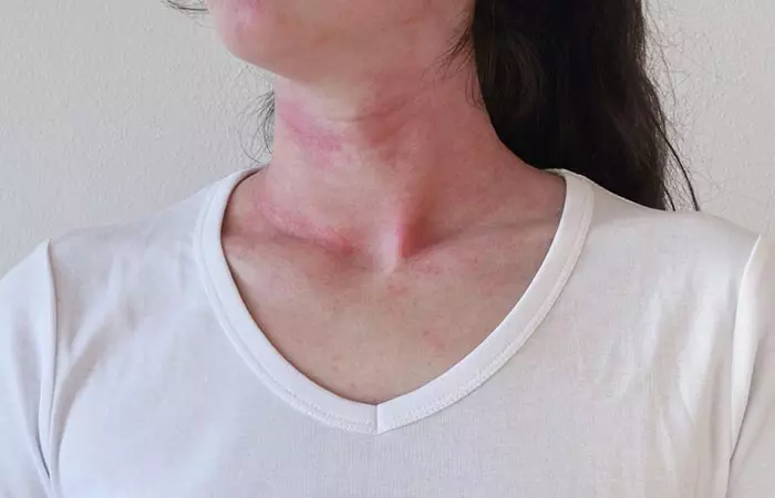 Woman with allergic reaction on neck due to coconut oil