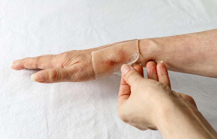 Silicone sheets for scar treatment