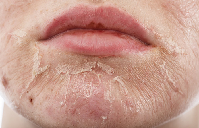 Woman with peeling facial skin