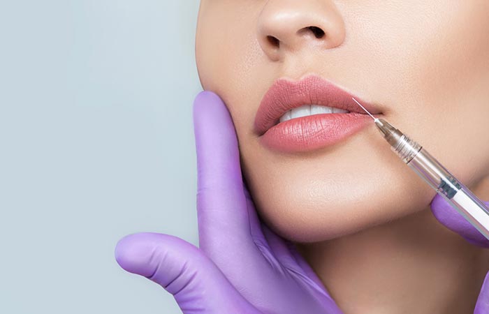 Filler injections may reduce wrinkles on the lips