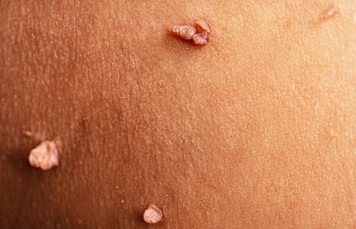Vaginal skin tag may be mistaken for vaginal pimples