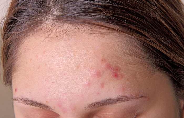 Closeup of acne scabs on woman's forehead