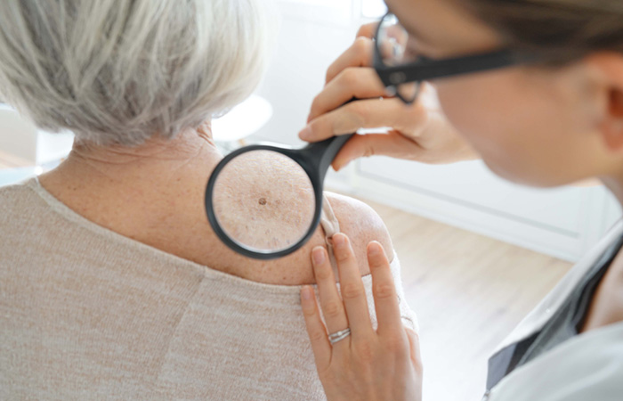Woman getting her skin checked by a dermatologist