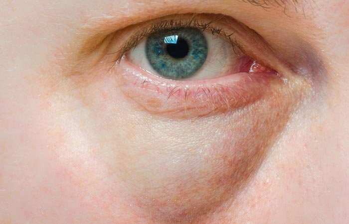 Swollen under-eyes is a common temporary side effect of under-eye fillers