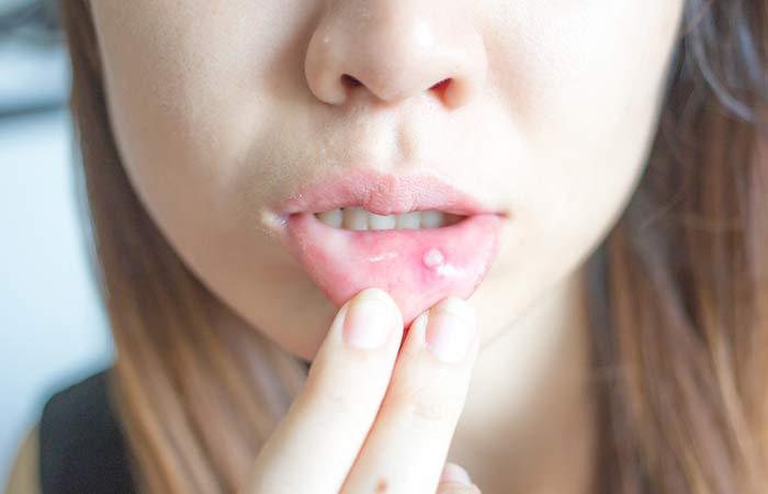 Che cos'è un mal di cancro?