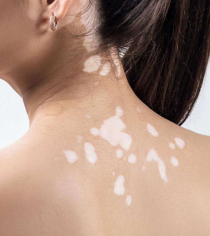 White Spots On Skin Causes And How To Get Rid Of Them