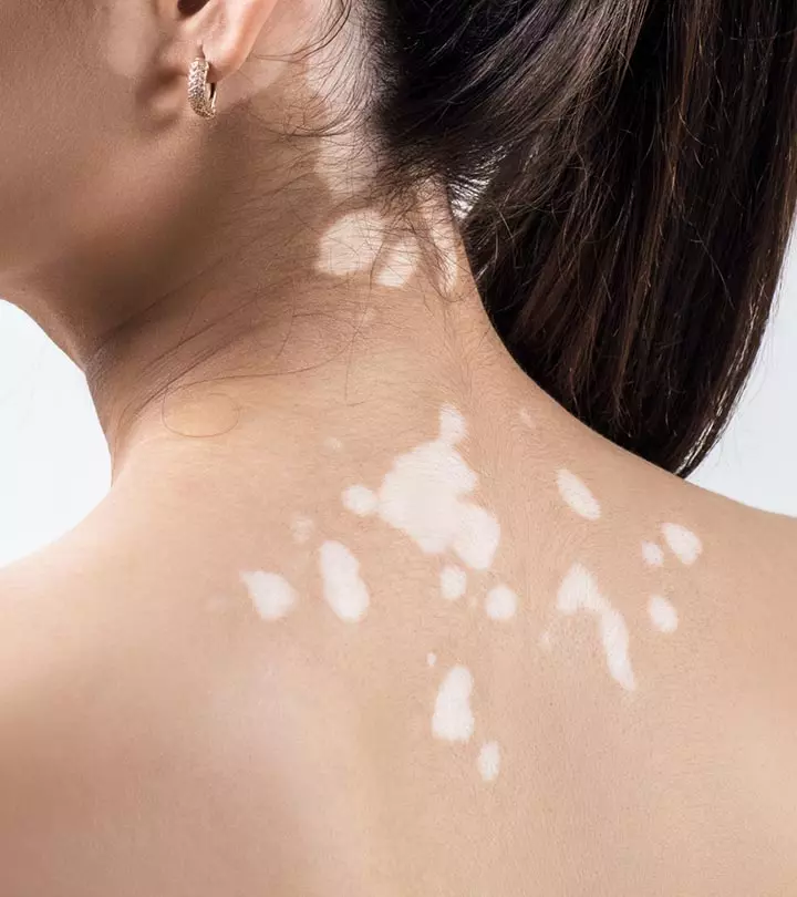 White Spots On Skin Causes And Treatment Options